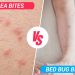 bed bug bites vs flea bites