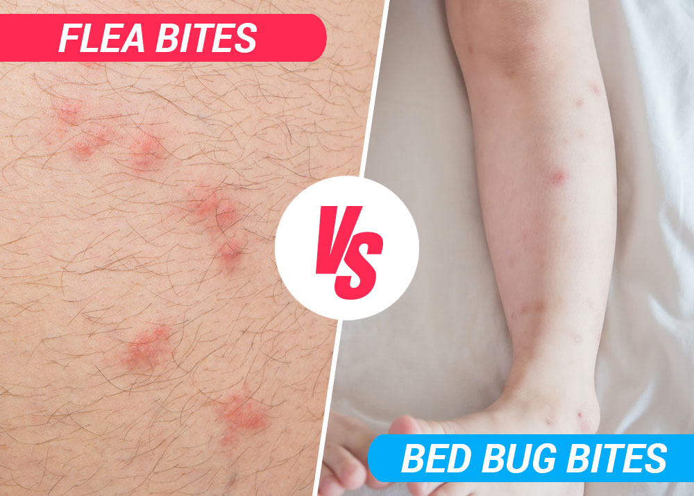 How to Tell the Difference Between Flea Bites, Bed Bug Bites, and